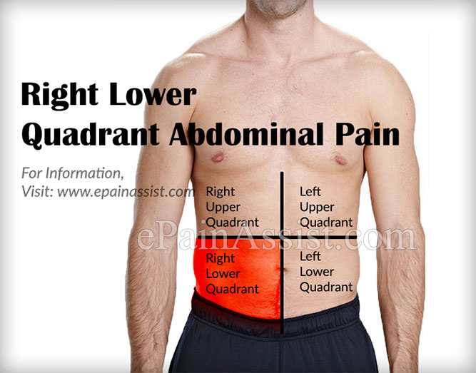 What Can Cause Right Lower Quadrant Abdominal Pain & How is it Treated?