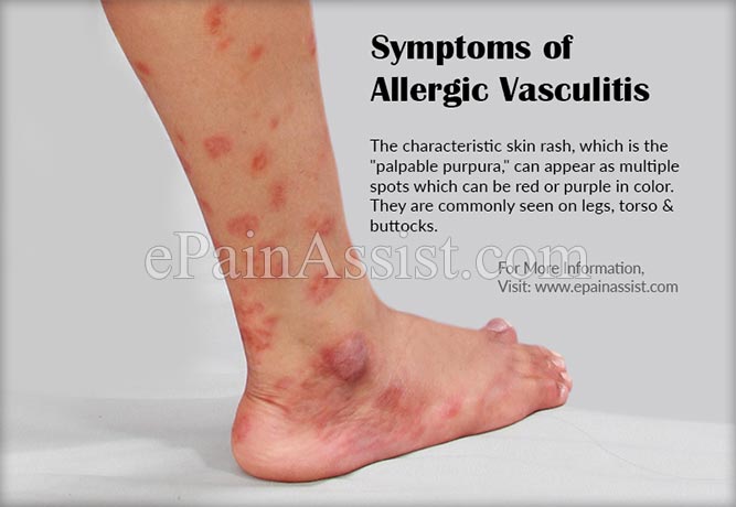 What is Hypersensitivity Vasculitis or Allergic Vasculitis & How is it ...