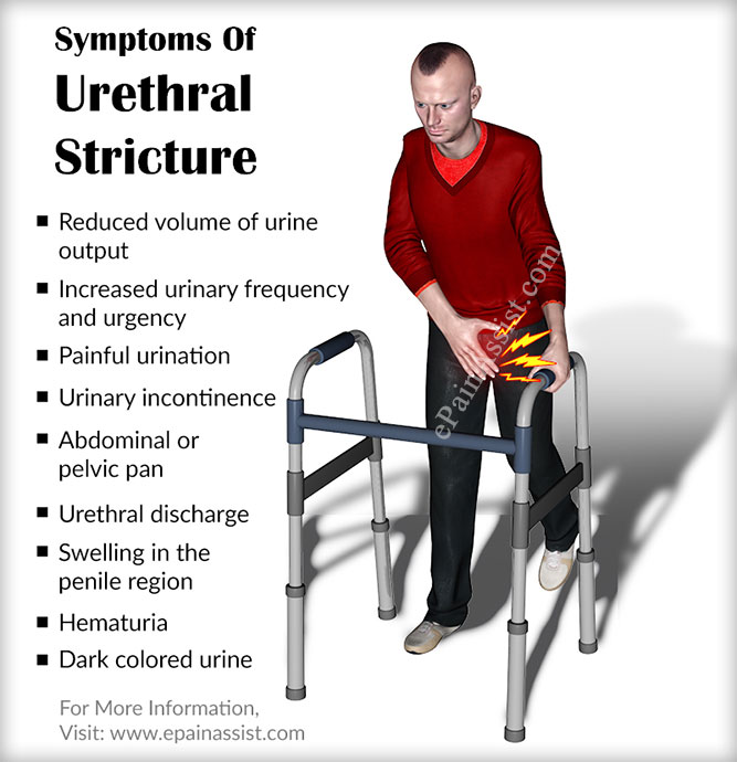 Symptoms Of Urethral Stricture