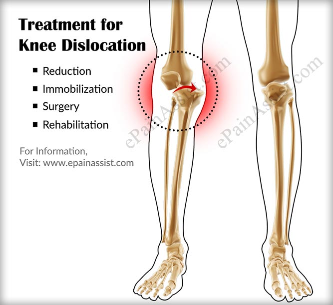 knee out of socket symptoms