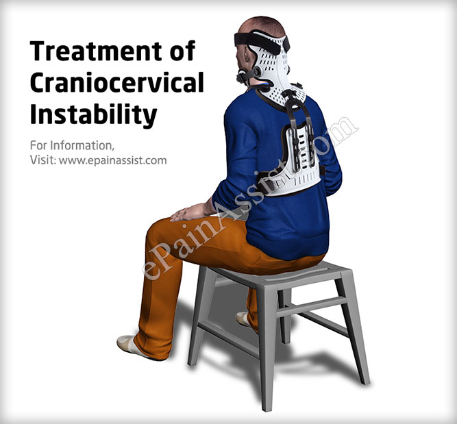 Symptoms of Craniocervical Instability