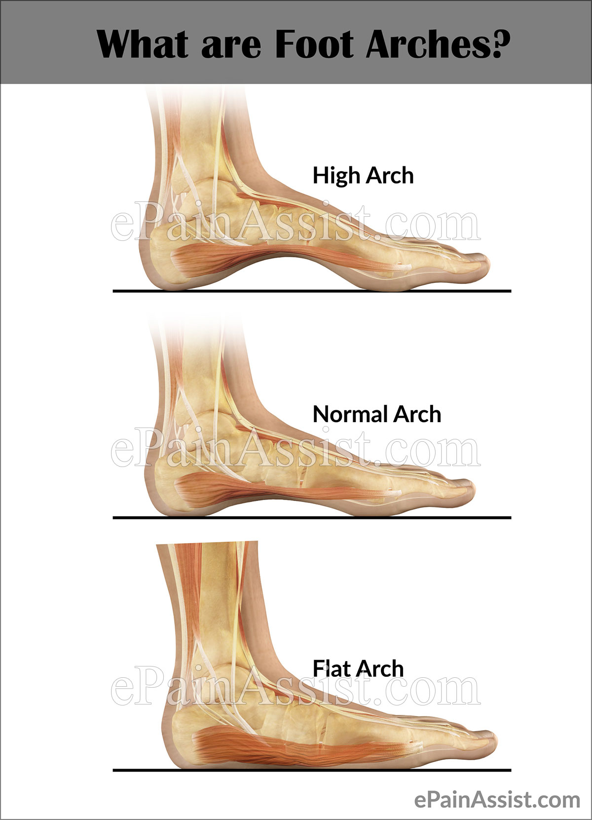 A Closer Look At The Arches Of The Foot MASS4D® Foot Orthotics | vlr.eng.br
