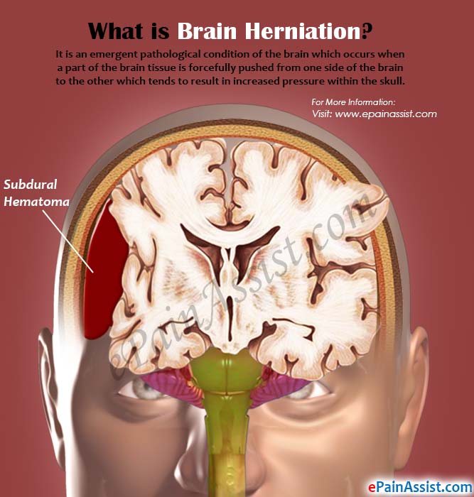 What is Brain Herniation?