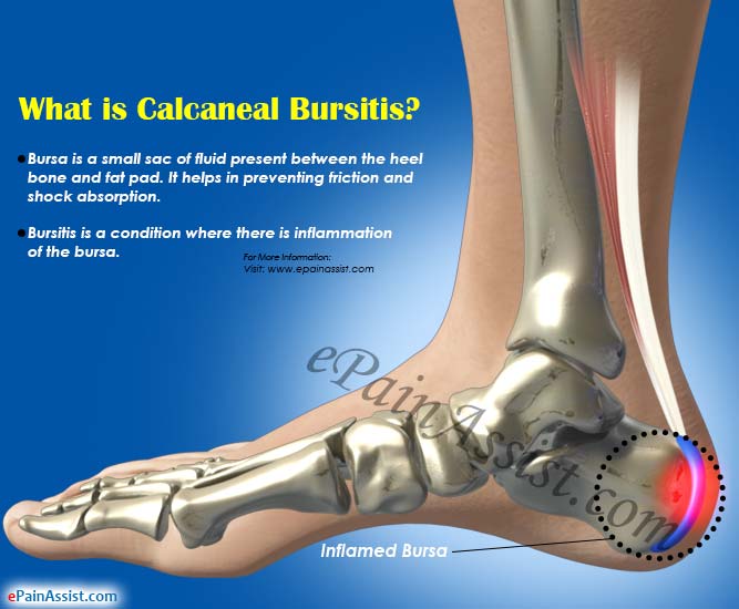 heel bursitis causes