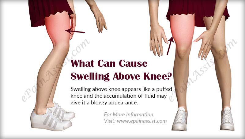 What Can Cause Swelling Above Knee And What Is Its Treatment