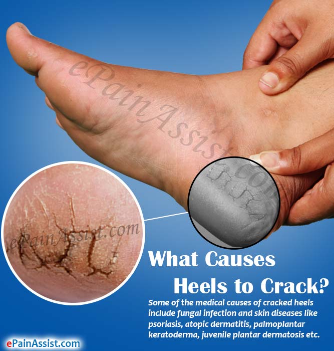 painful cracked heels