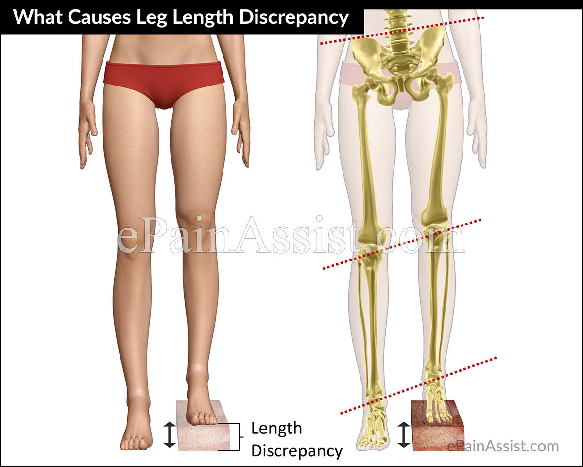 Common causes and conditions of Leg Length Discrepancy (LLD)