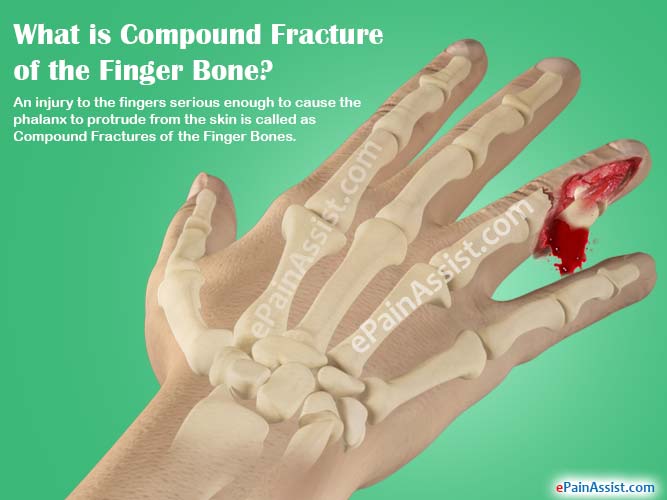 Compound Fracture Of The Finger Bones Causes Symptoms Treatment