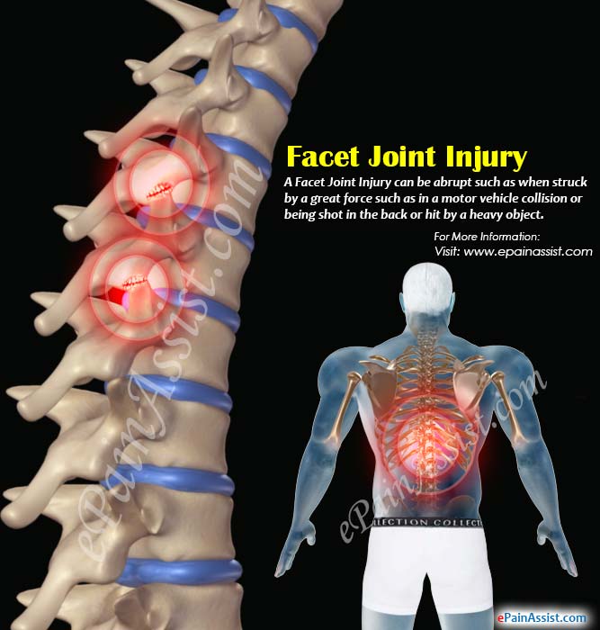 What is Facet Joint Injury