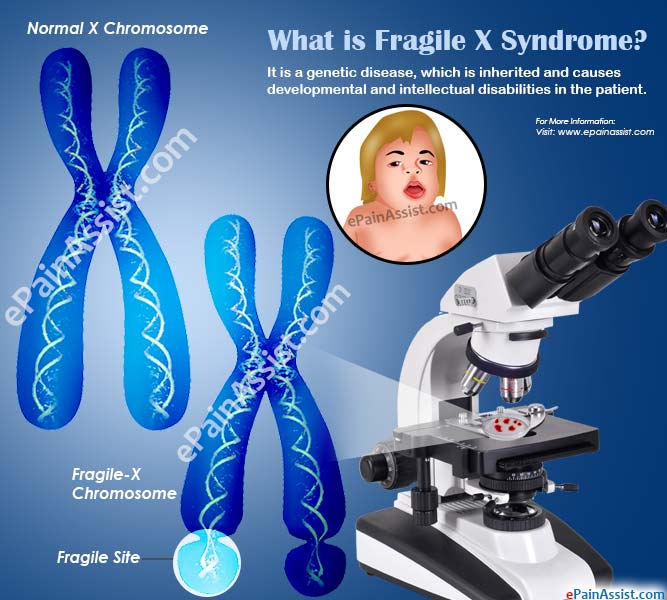 Fragile X Syndrome Symptoms Treatment Life Expectancy Prognosis Causes