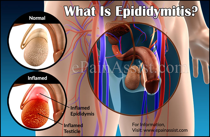 Epididymitis Treatment Recovery Causes Symptoms Coping Tips