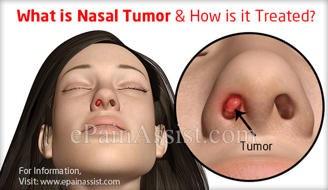 nasal cancer