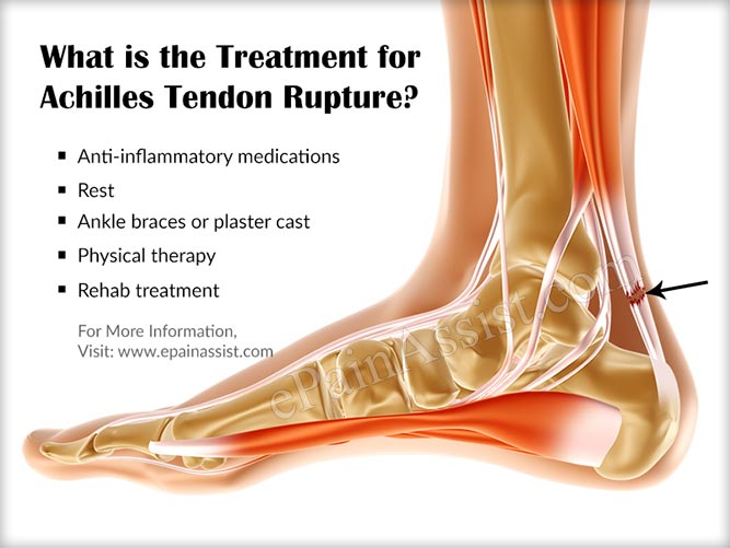 Is Achilles Tendon Rupture a Common Injury|Causes, Symptoms, Treatment ...