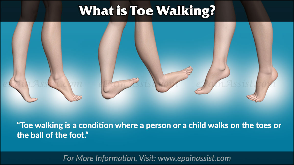 Toe walking, idiopathic
