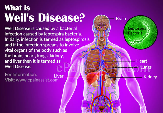What is Weil's Disease?