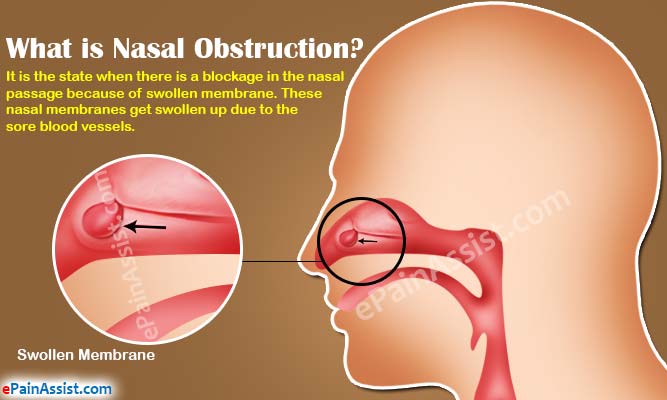 nasal blockage