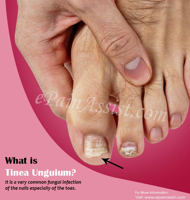 What is Tinea Unguium, Know its Causes, Symptoms, Treatment, Prognosis,  Pathophysiology, Diagnosis