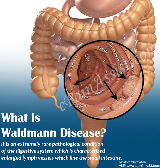 What is Waldmann Disease?